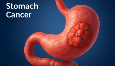 Stomach Cancer Illustration
