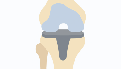 Total Knee Replacement Drawing