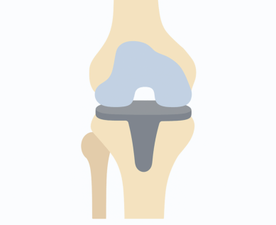 Total Knee Replacement Drawing