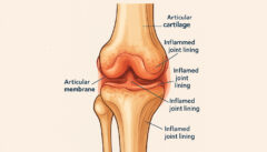 Arthritis illustration