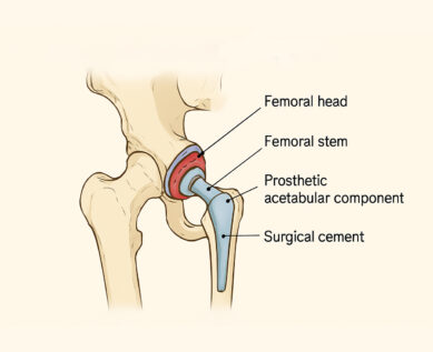 Cemented Total Hip Replacement