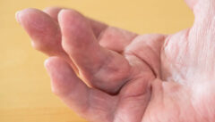 Dupuytren's disease