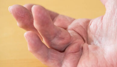 Dupuytren's disease