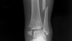 Xray of a Fracture