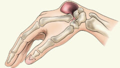 Ganglion Cyst