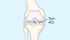 Ligament Tear