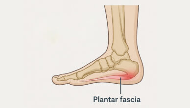 Plantar fasciitis